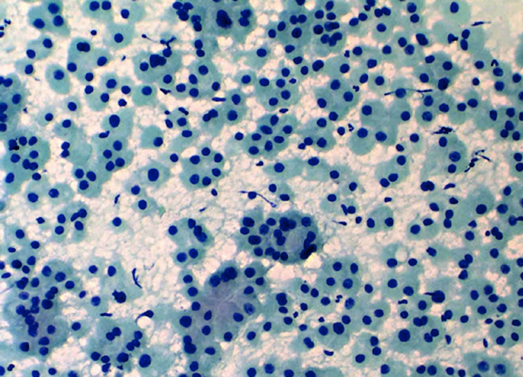 pathology-outlines-follicular-neoplasm